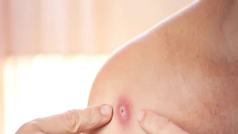 الطفح الجلدي أبرز أعراض الإصابة بجدري القرود