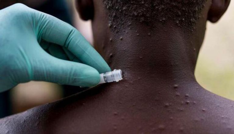 اختبارات جدري القرود - أرشيفية