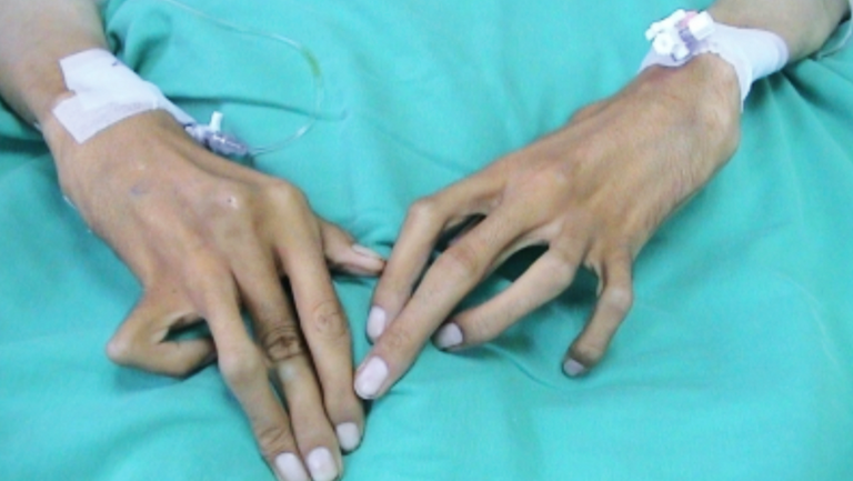 لا يمكن الشفاء من متلازمة مارفان