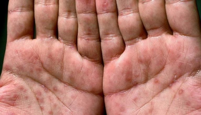 يد شخص مصاب بأعراض الإيدز- أرشيفية