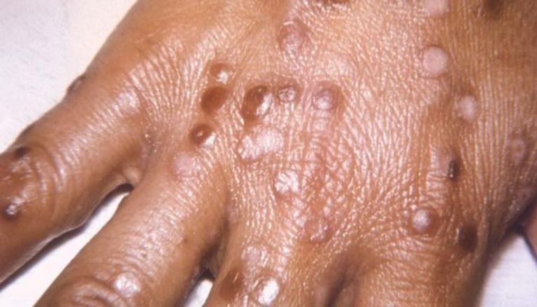 الطفح الجلدي أبرز أعراض جدري القرود