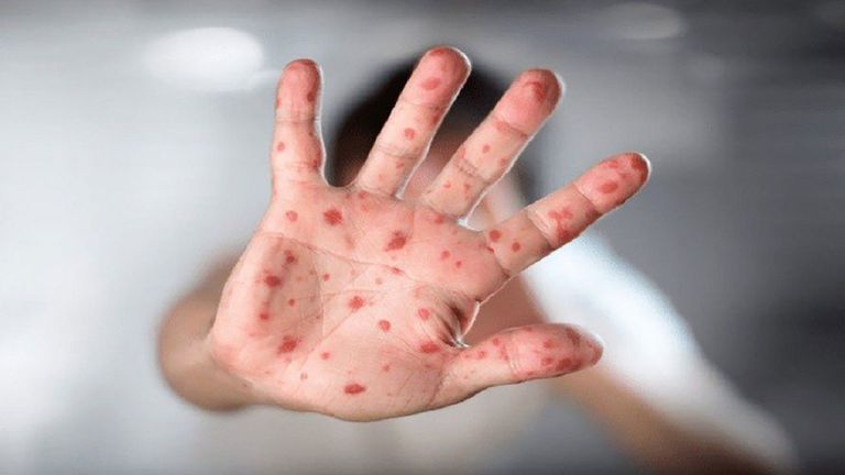 جدري القرود عدوى فيروسية نادرة مشابهة للجدري البشري