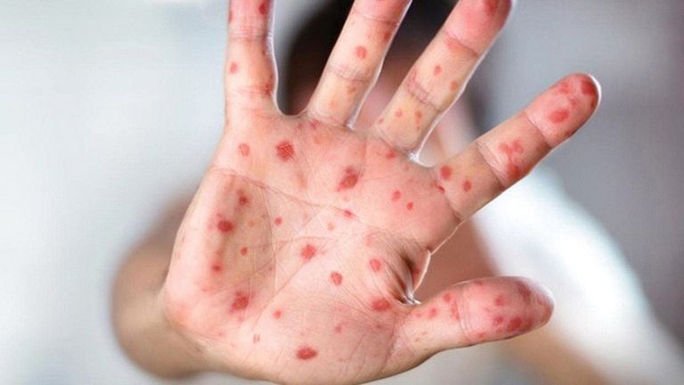 20 دولة أبلغت عن تفشي جدري القرود بها