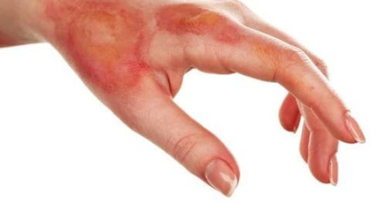 حروق اليد يجب التعامل معها بالمياه الفاترة وليست الباردة أو الساخنة