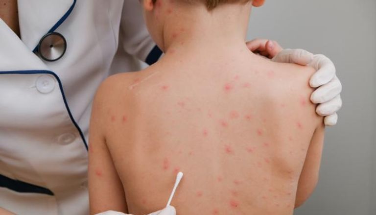 جدري القردة