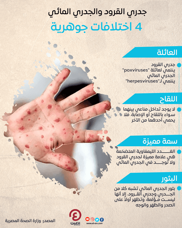 طفلة مصابة بالجدري المائي