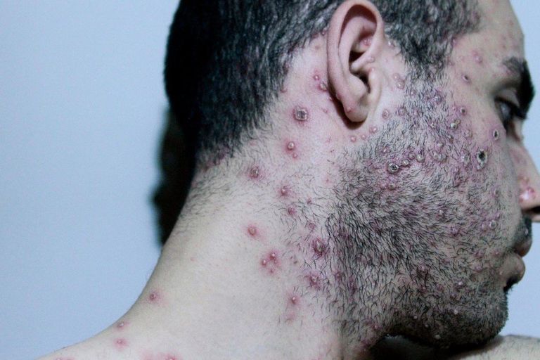 مريض بجدري القرود _ أرشيفية