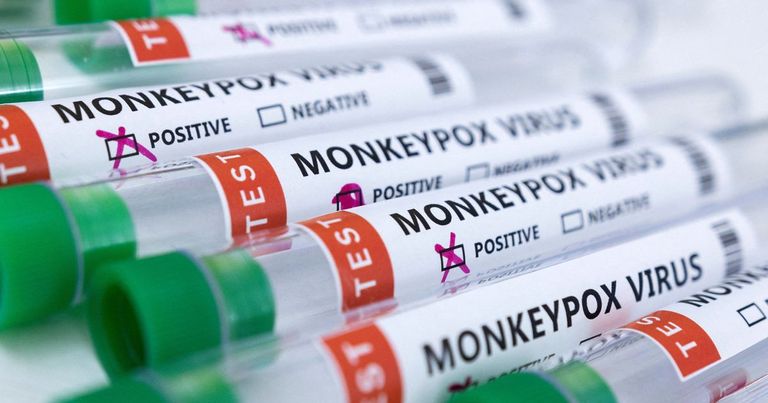 مريض بجدري القرود _ أرشيفية