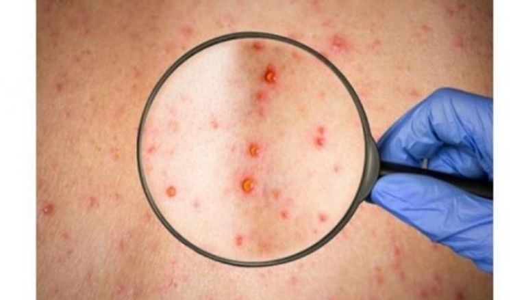 الإصابات تم تسجيلها في دول لا ينتشر بها جدري القرود