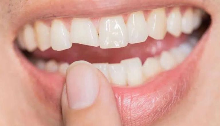 عض الأشياء الصلبة قد يؤدي لفقدان الأسنان - أرشيفية