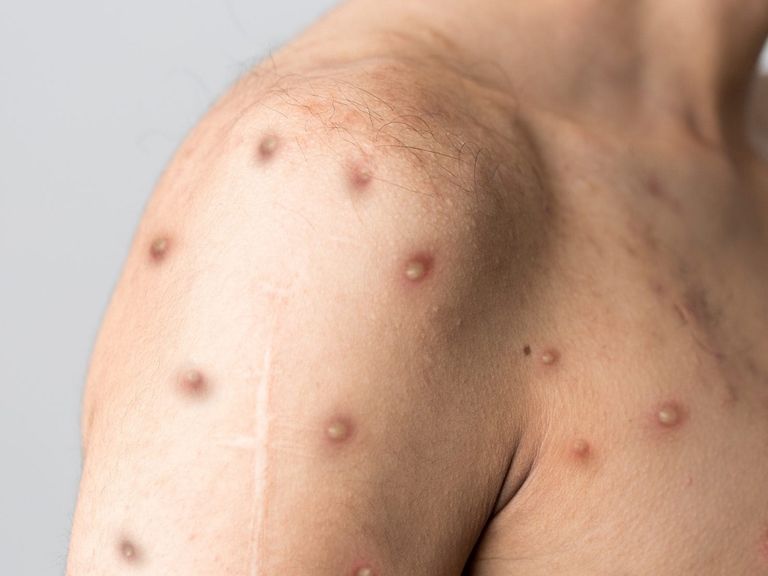 شخص مصاب بفيروس جدري القرود