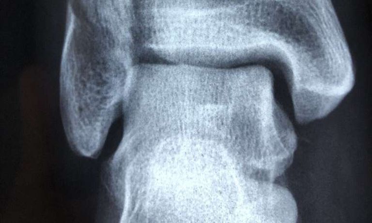 التدخين عامل خطر للإصابة بكسور العظام