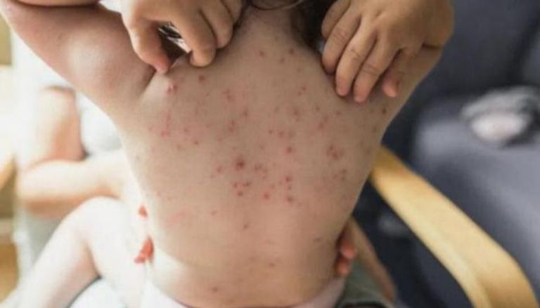 جدري القرود أحدث تفشٍّ للأمراض حيوانية المنشأ