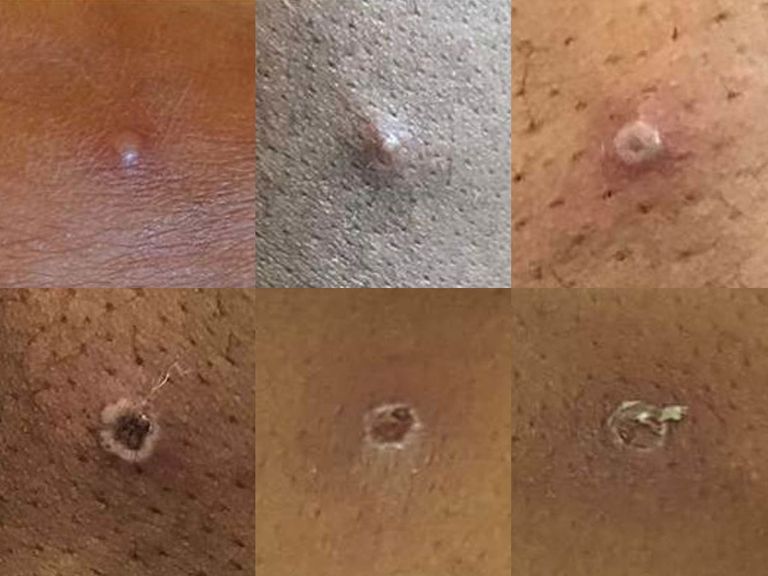 عينة إيجابية لجدري القرود - أرشيفية