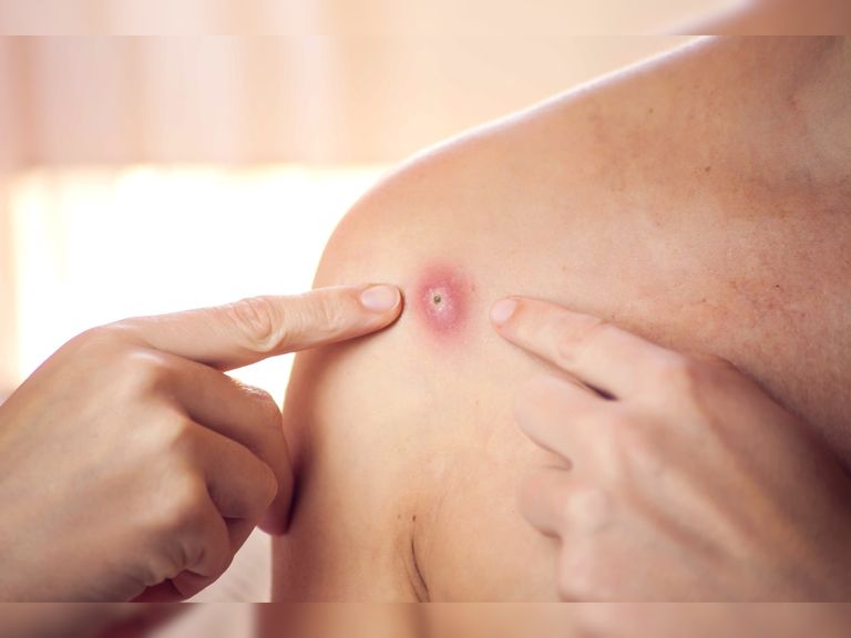 شخص مصاب بأعراض جدري القرود