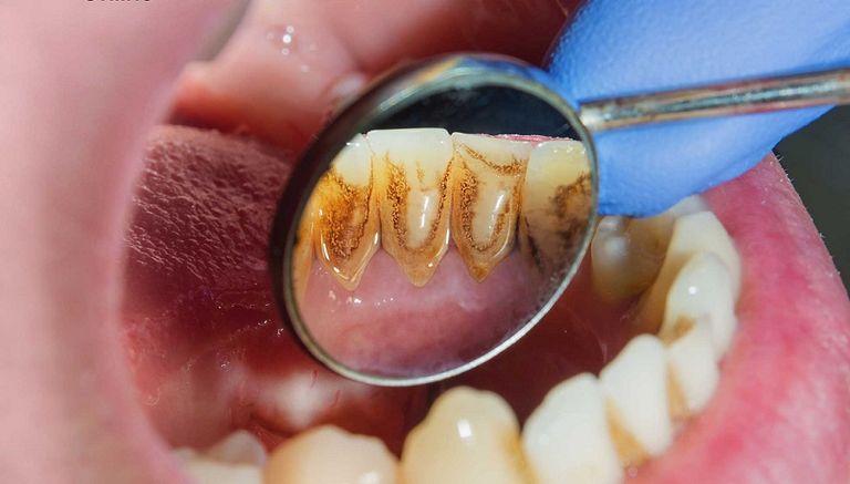 مشاكل الفم يمكن أن تكون علامة على أمراض الجسم