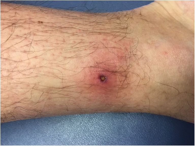 لدغات القراد تنقل العديد من الفيروسات والأمراض