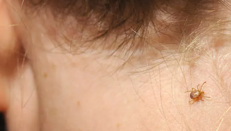 لدغات القراد تنقل العديد من الفيروسات والأمراض