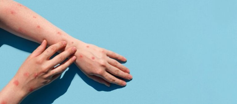 مرض جدري القردة بات موجودا الآن في عدة قارات