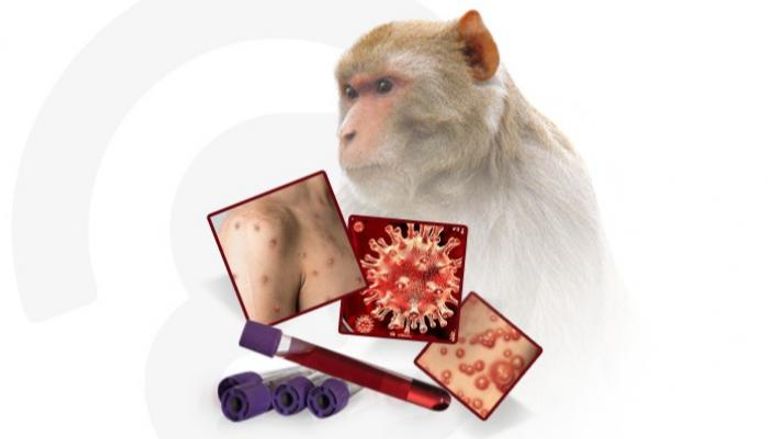 أعراض غير معتادة لجدري القرود