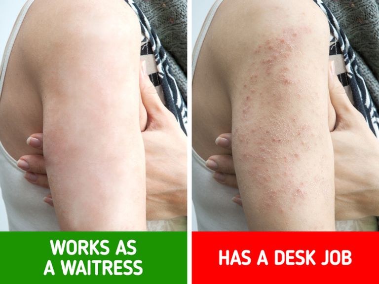 أعراض تحذرك من الجلوس كثيرًا