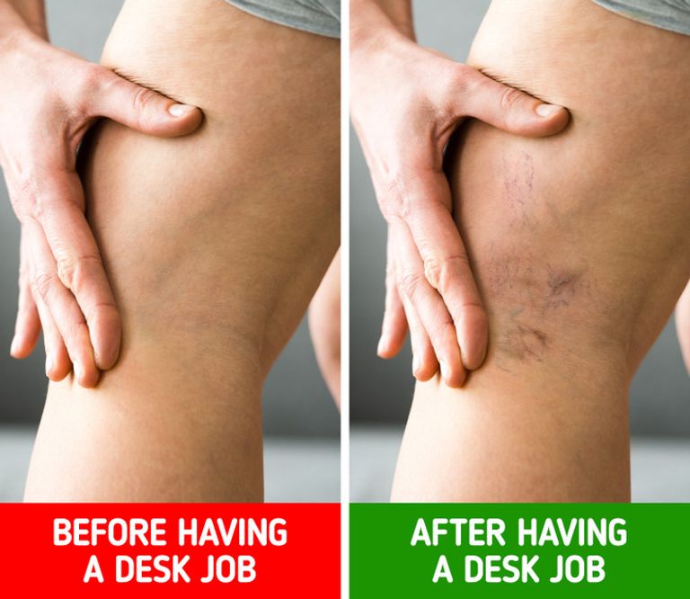 أعراض تحذرك من الجلوس كثيرًا