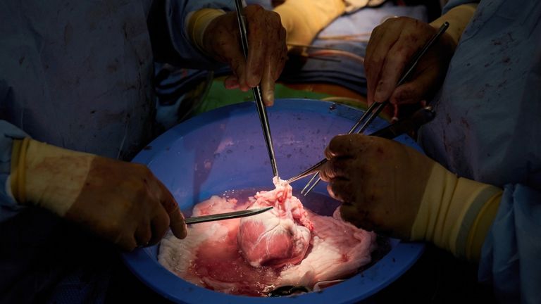 جانب من التدخل الجراحي لنقل قلبي خنزيرين مُعدلين وراثيا لشخصين 