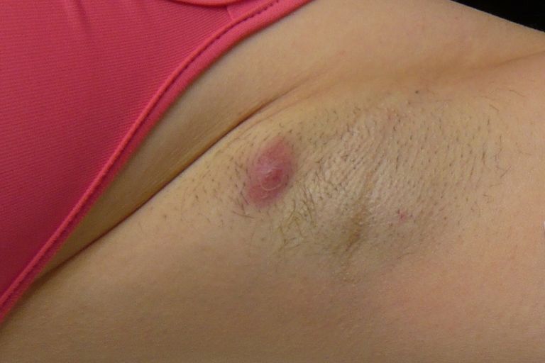 من أعراض التهاب الغدد العرقية القيحي