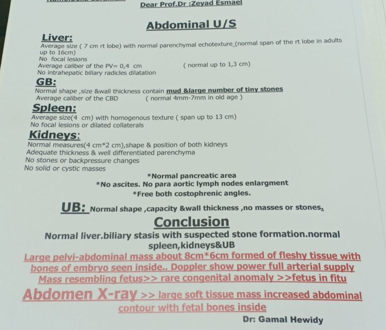 الأشعة تظهر جنينًا في بطن طفلة الدقهلية 