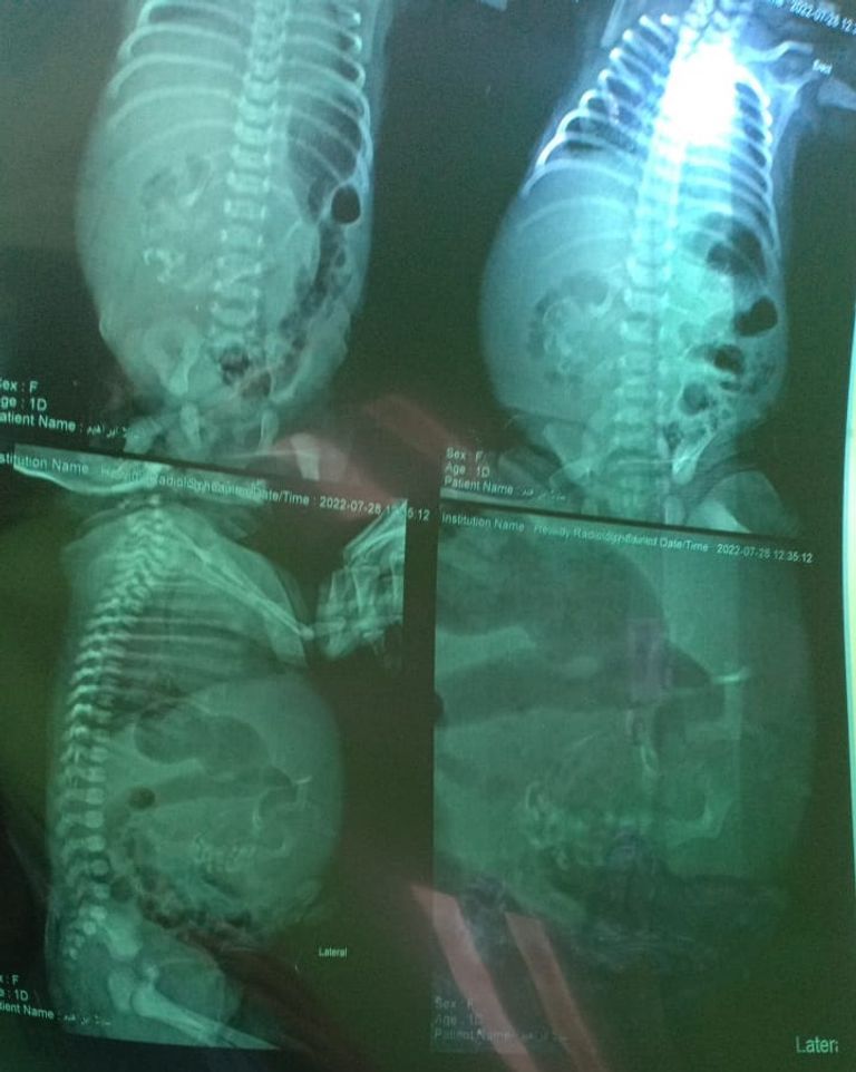 الأشعة تظهر جنينًا في بطن طفلة الدقهلية 