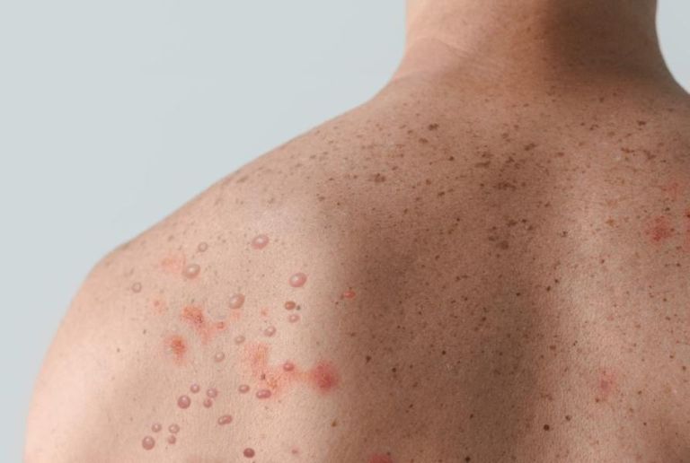 مريض مصاب بجدري القرود