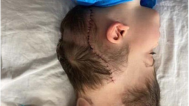 التوأم البرازيلي بعد فصلهما