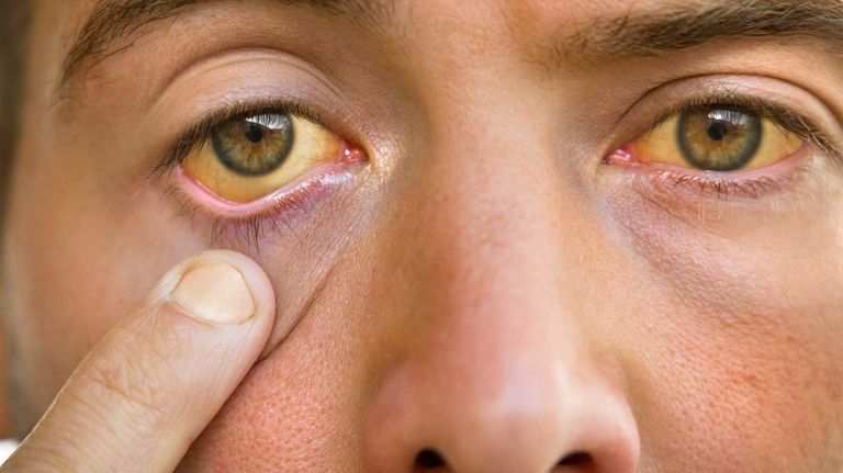 اليرقان من أعراض الفشل الكبدي شخص مصاب بأعراض الفشل الكبدي