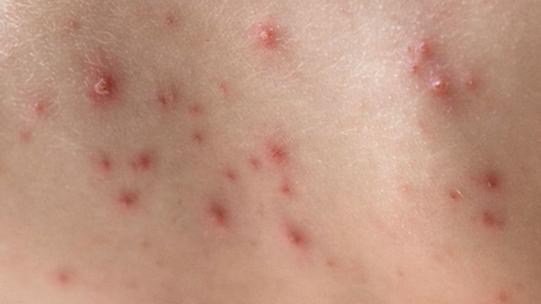 شخص تظهر عليه أعراض فيروس جدري القرود