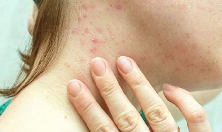 أحد اللقاحات المستخدمة للوقاية من جدري القرود