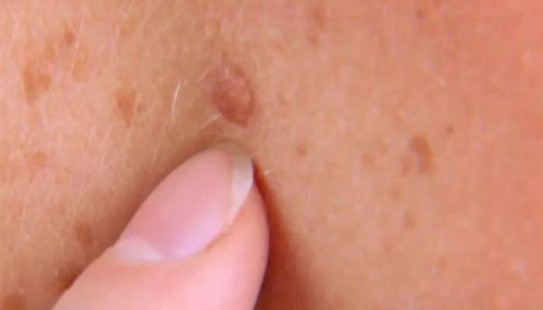 العلاج بالكورتيزون قد يخلف تصبغات لونية في الجلد