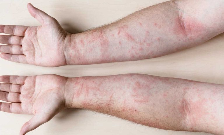 شخص مصاب بأعراض بمرض التهاب المفاصل الصدفي