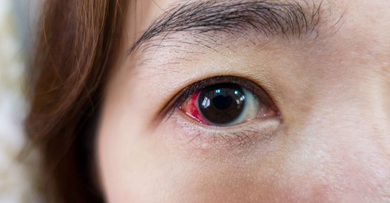 انفصال الشبكية يعد من أبرز أسباب الإصابة بالعمى- أرشيفية