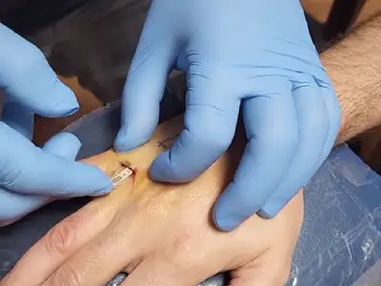 عملية زراعة الشريحة