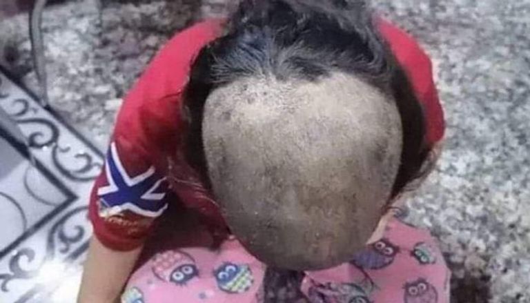 الطفلة تبارك بعد حلق رأسها 
