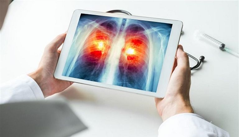 المرضى يعانون من التهاب رئوي غامض- توضيحية