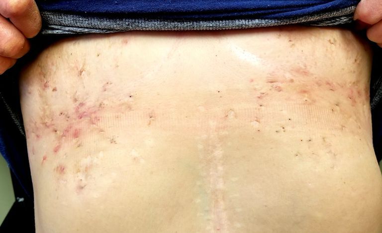 التهاب الغدد العرقية القيحي