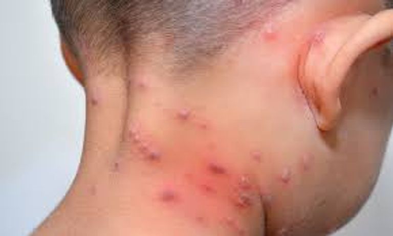 أعراض جدري القرود- أرشيفية