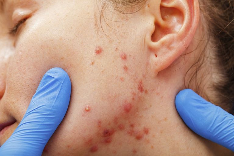 عدم انتظام الدورة الشهرية من علامات تكيس المبايض - أرشيفية