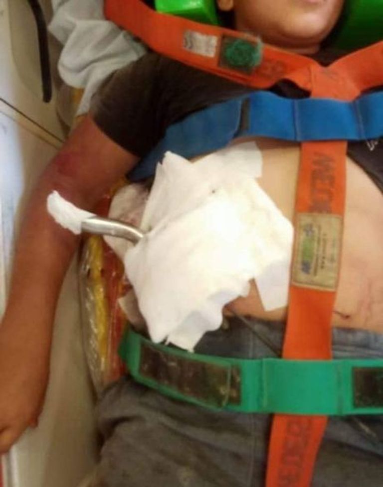 مقود الدراجة بعد استخراجه من بطن الطفل