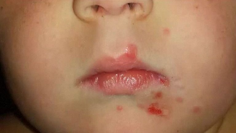 الطفح الجلدي من أبرز أعراض المرض- توضيحية