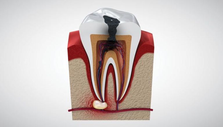 أسباب وعلاج التهاب جذور الأسنان