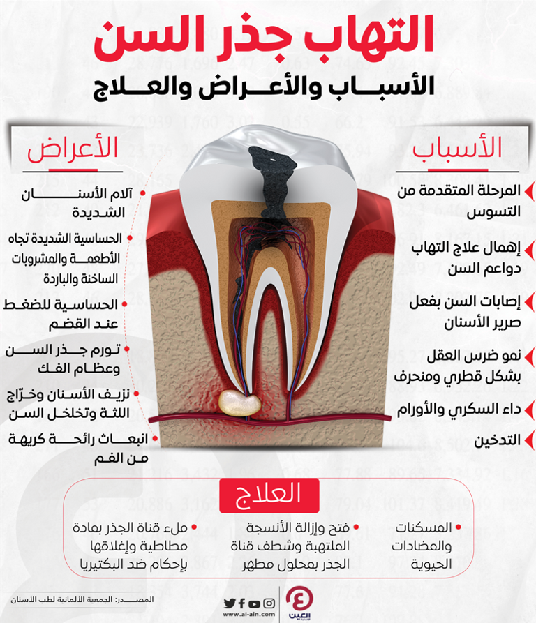 أسباب وعلاج التهاب جذور الأسنان