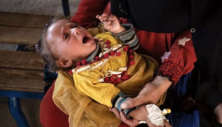 طفل سوري يعاني من الكوليرا