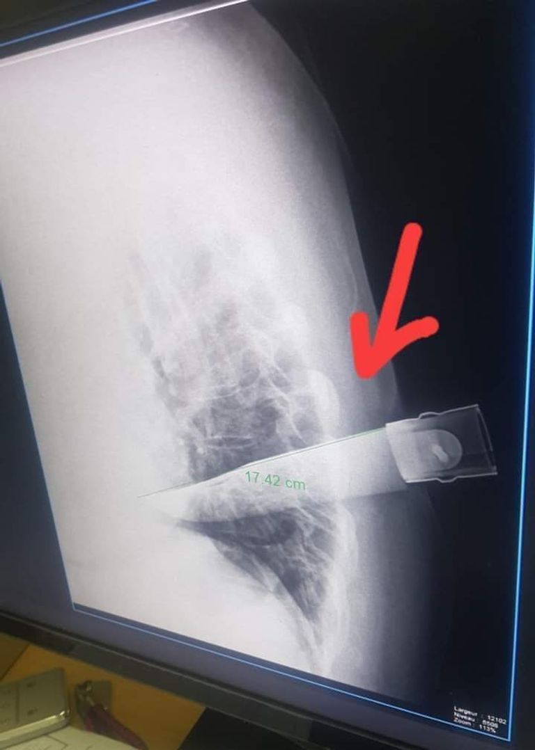 أشعة تظهر طعنة الخنجر في ظهر المعلمة المعلمة ريحانة بن شية من داخل المستشفى